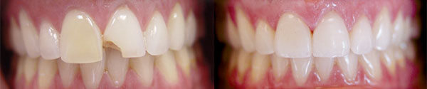 Porcelain Veneers Before and After - Jackson Smiles Family Dentistry