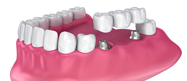 dental bridge illustration