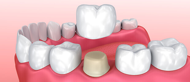 dental crown illustration