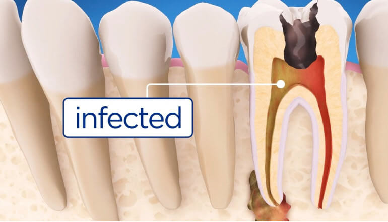 model showing infected tooth needing root canal therapy