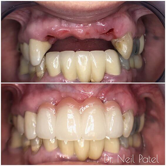 Before and after photo of tooth replacements