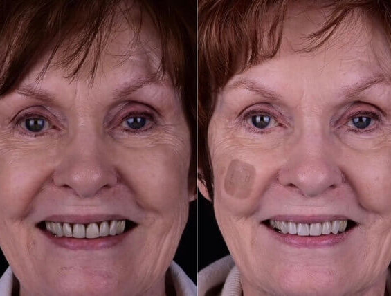 Before and after photo of smile makeover