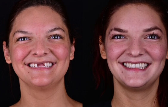 Before and after photo of smile makeover