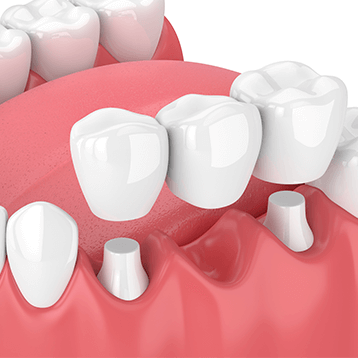 illustration of dental bridge