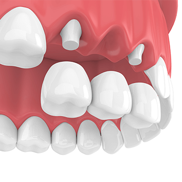 illustration of dental bridge