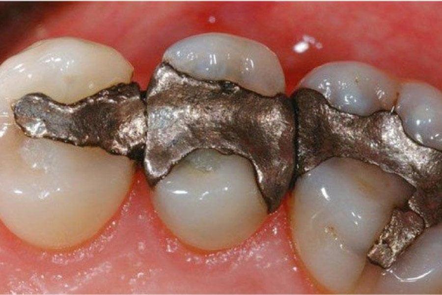 amalgam dental fillings