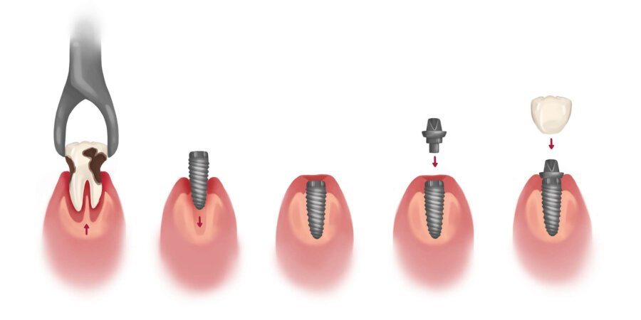 Illustration of the process to get dental implants: extraction, getting the implant, healing, and topping it with a dental crown