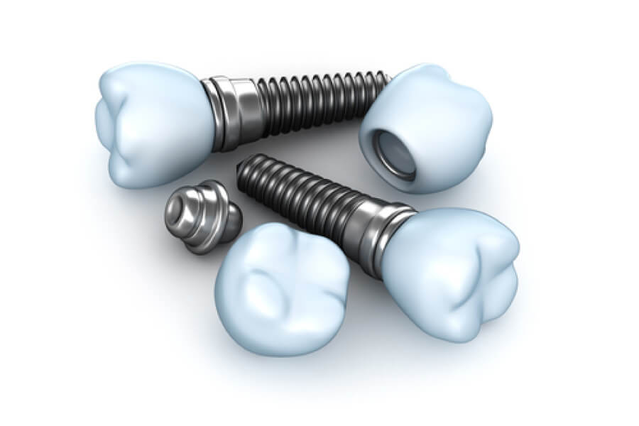 dental implant components